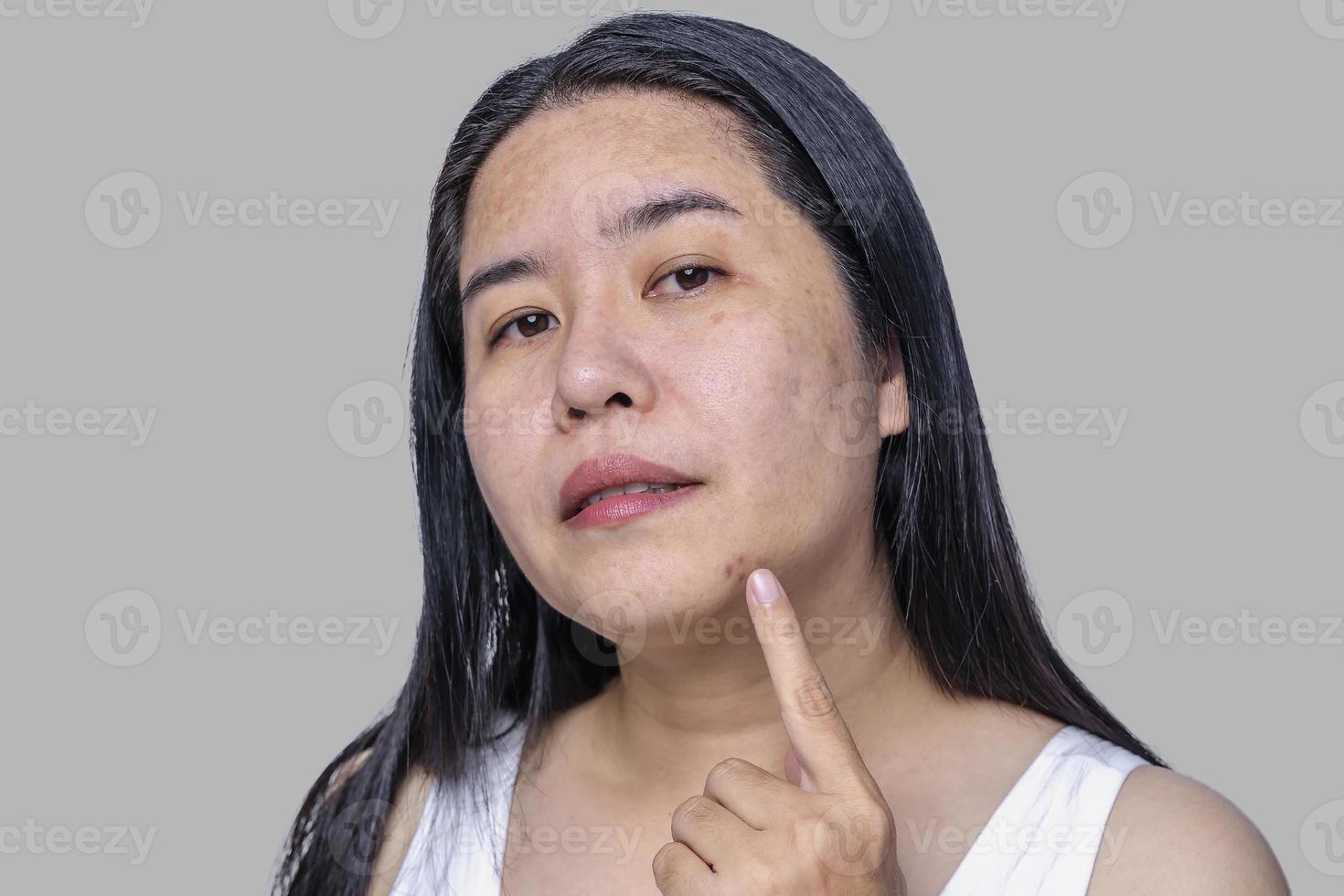 Close up of Asian adult woman face has freckles, large pores, blackhead pimple and scars problem from not take care for a long time. Soft focus of skin problem face. Treatment and Skincare concept photo