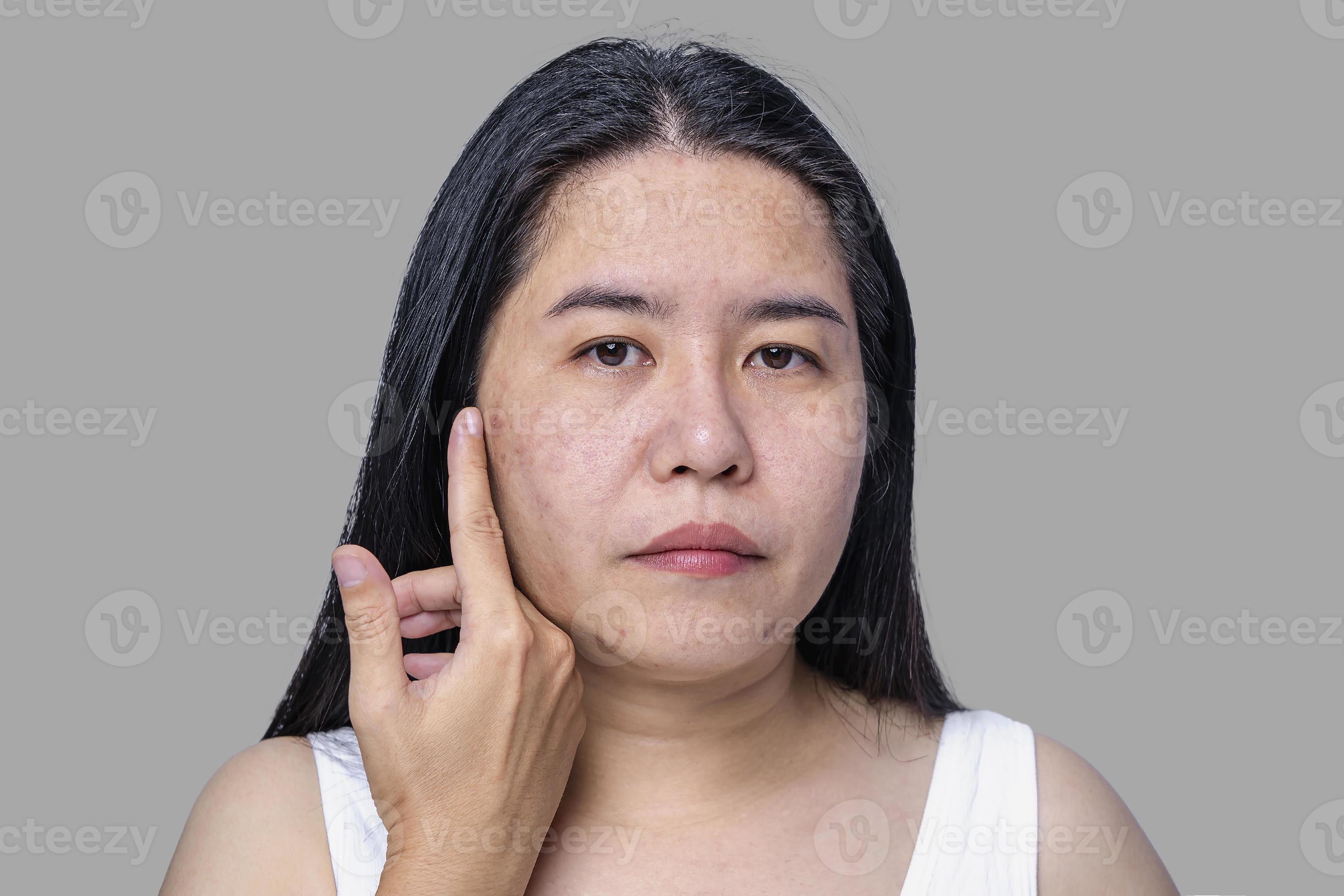 Big Blackhead Pimple - 9kp33zk