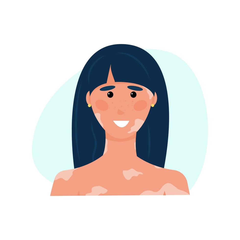 happy woman with vitiligo. Brunette with dipigmentation. The girl suffers from genetic and immune problems with the skin of her face and body. Vector illustration, flat