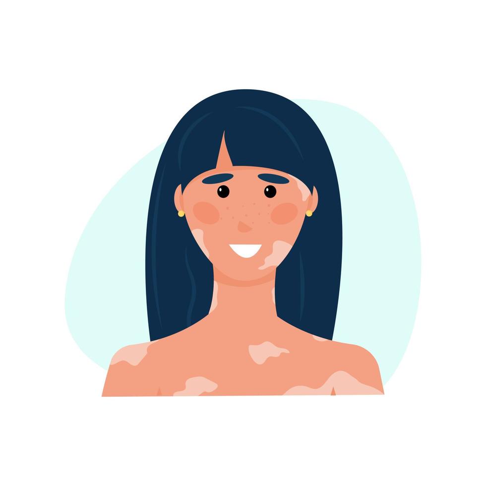 mujer feliz con vitíligo. morena con dipigmentación. la niña sufre problemas genéticos e inmunológicos en la piel de su cara y cuerpo. ilustración vectorial, plano vector