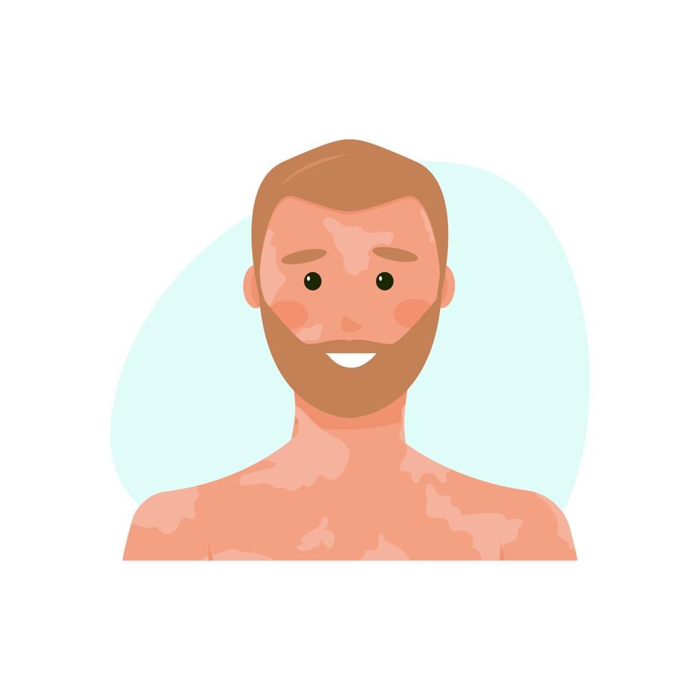 hombre feliz con vitíligo. persona rubia con dipigmentación. el chico sufre de problemas genéticos e inmunológicos con la piel de su cara y cuerpo. ilustración vectorial, plano vector