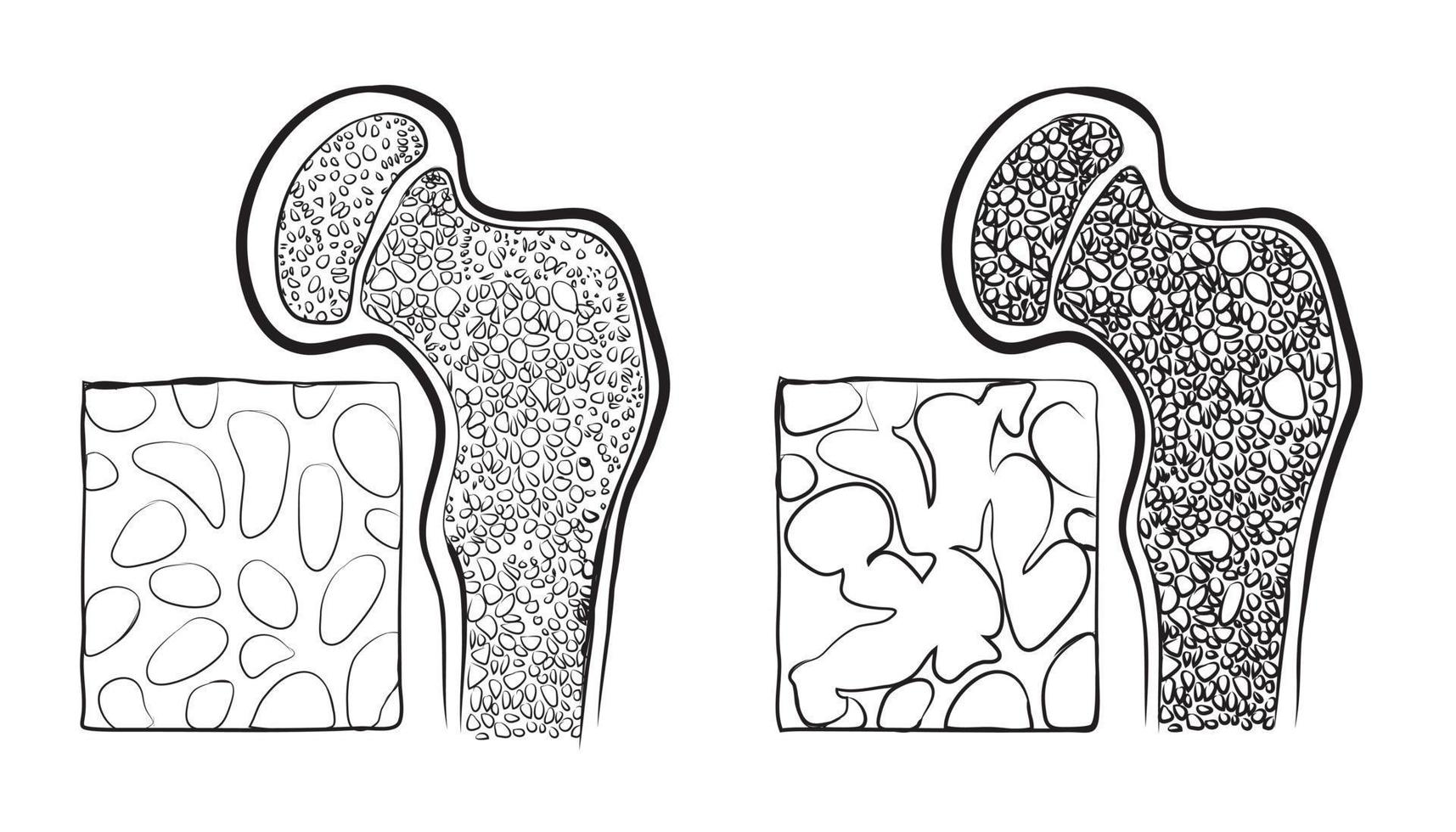 fémur osteoporosis eps vector