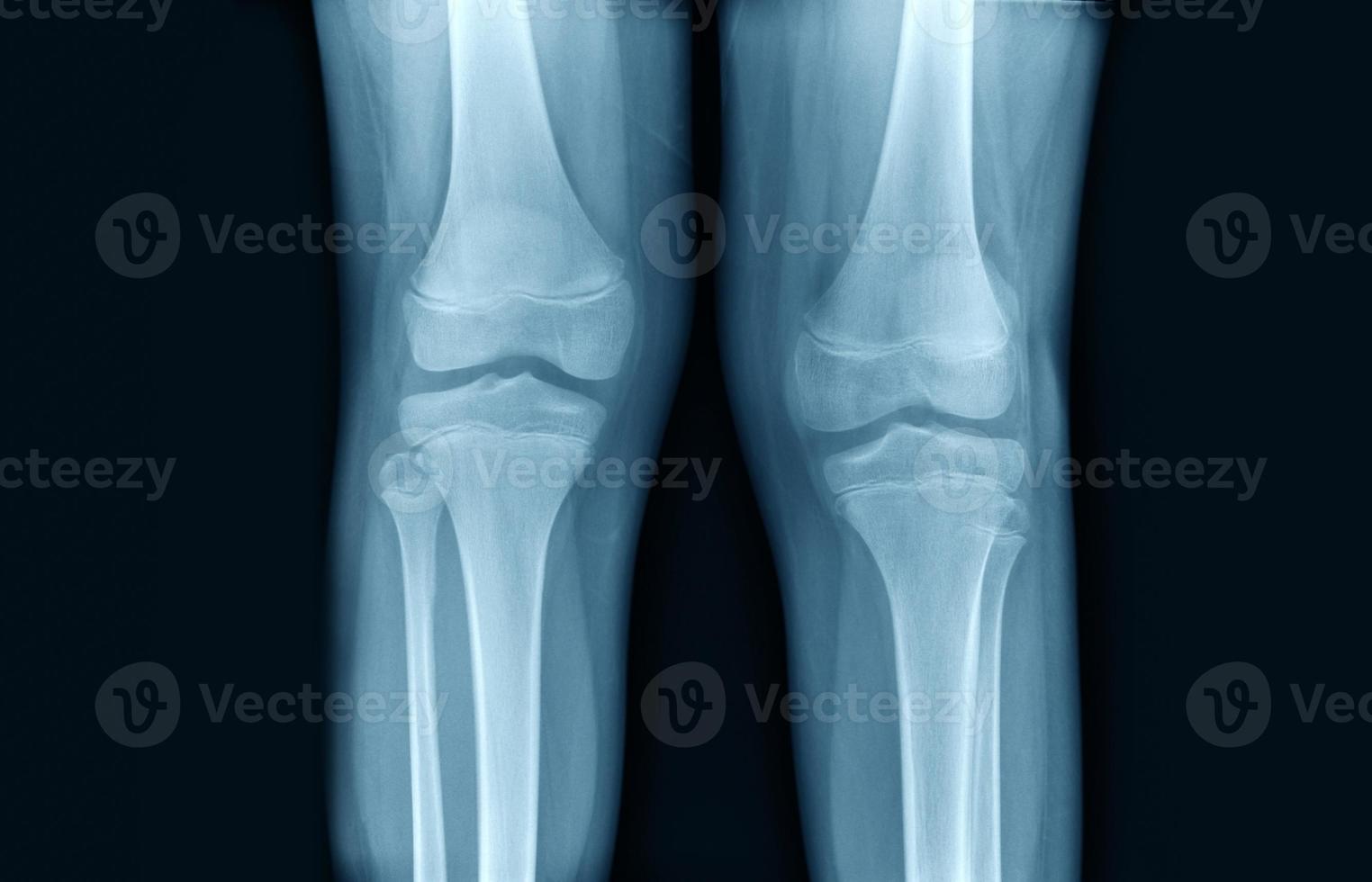 radiografía de la articulación de la rodilla en tono azul foto