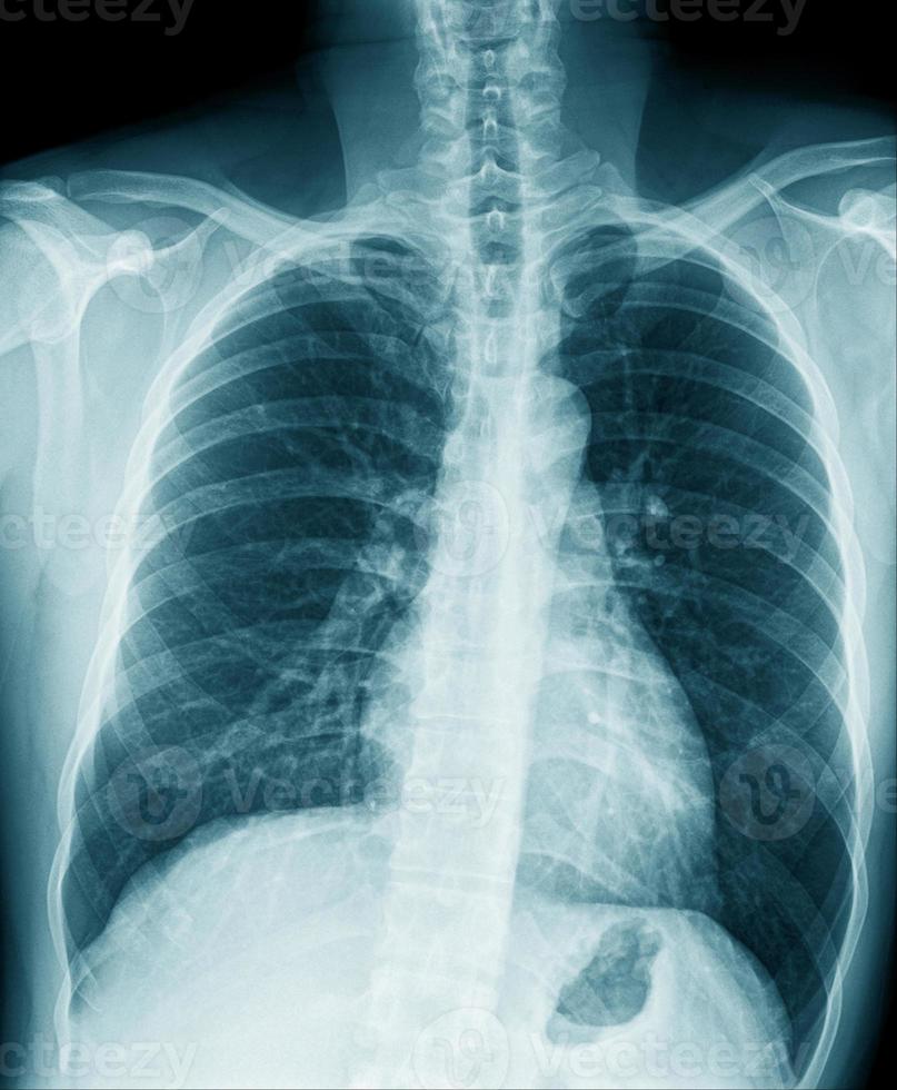 chest x-ray image in blue tone photo