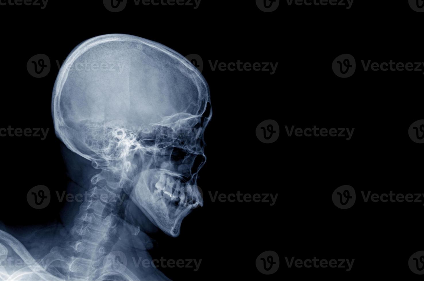 cráneo humano de rayos x sobre fondo negro foto
