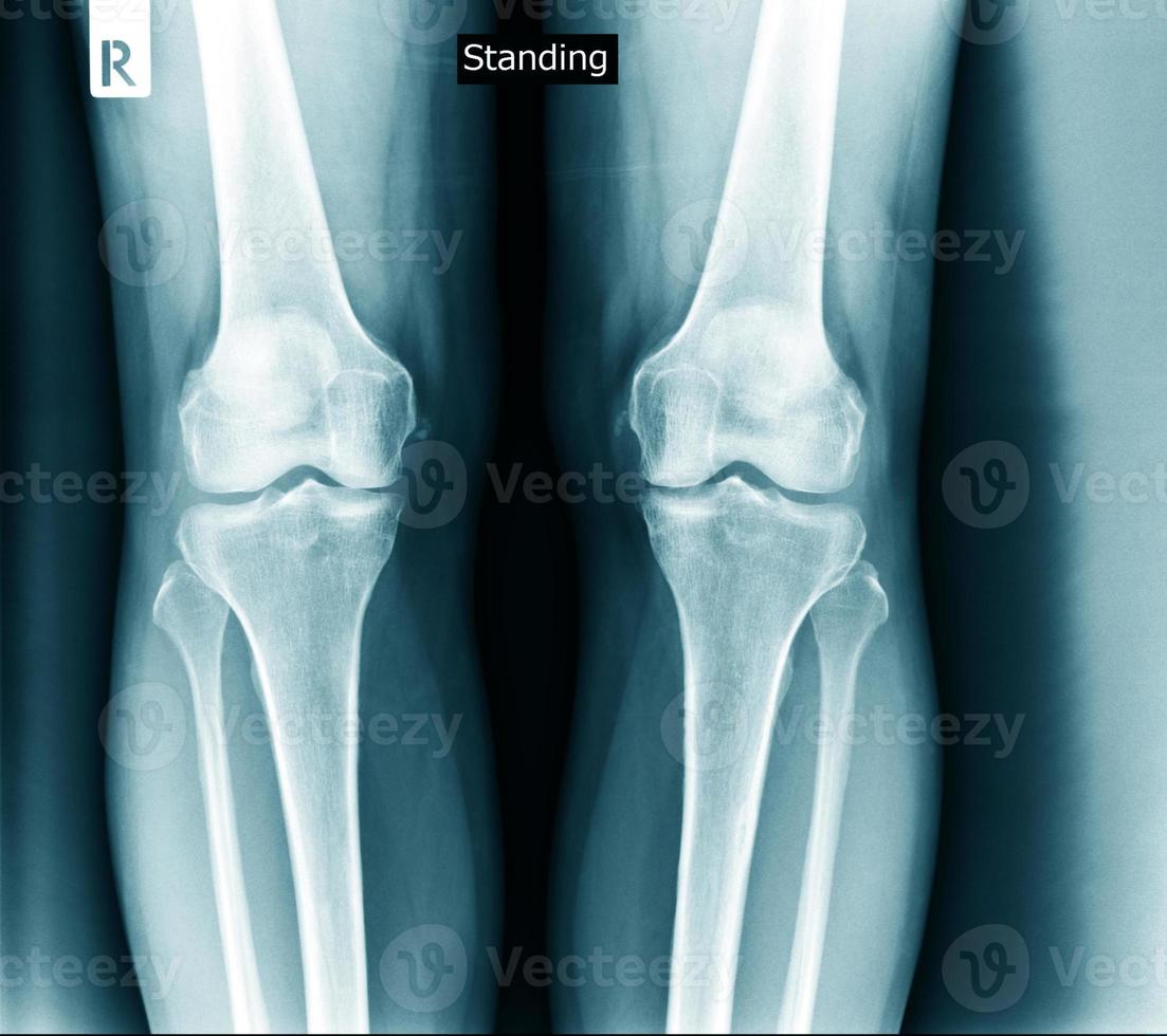 knee joint x ray degeneration photo