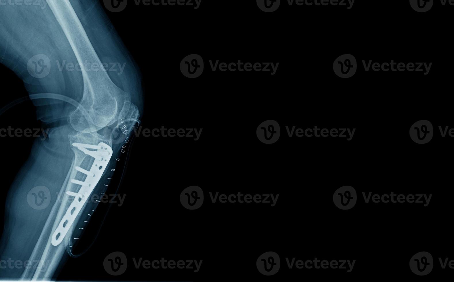 lateral view of proximal tibia photo