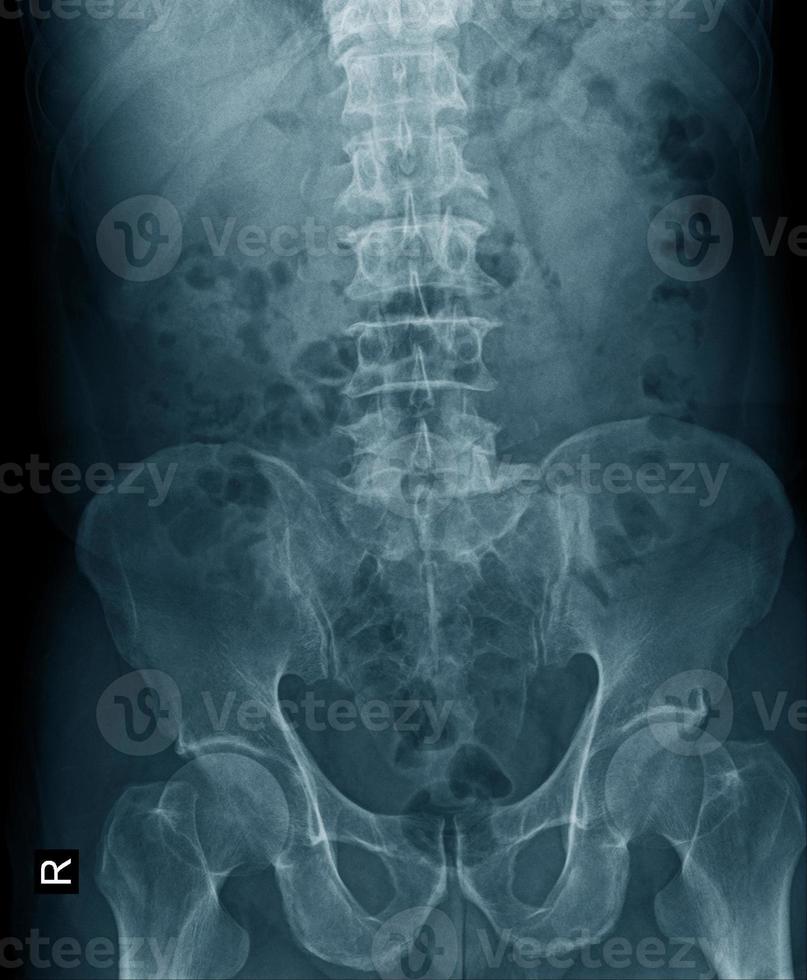 x-ray image of lumbo sacral photo