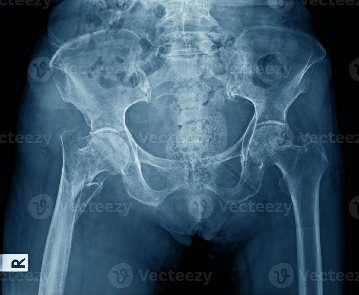 imagen de rayos x del hueso pélvico foto