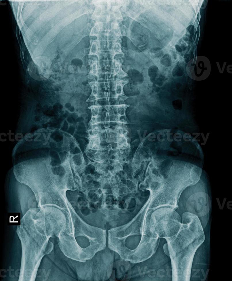 x-ray image of lumbo sacral photo