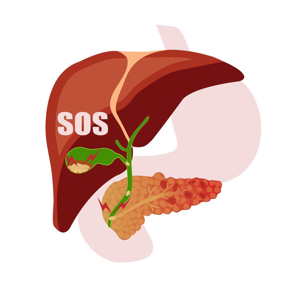 Illustration showing Inflamed pancreas, gallstones blocking   pancreatic duct Vector illustration.