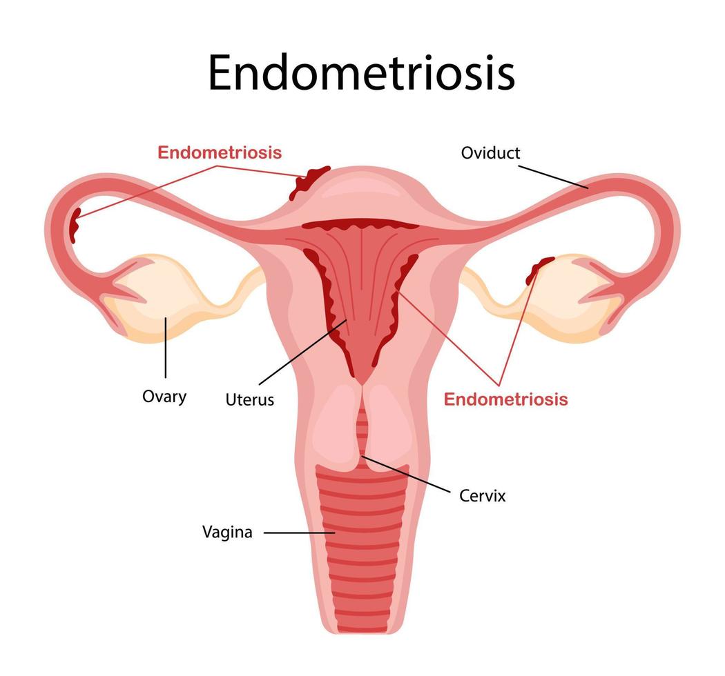 diagrama de endometriosis. enfermedades del aparato reproductor femenino. ilustración vectorial en un estilo de caricatura plana. vector