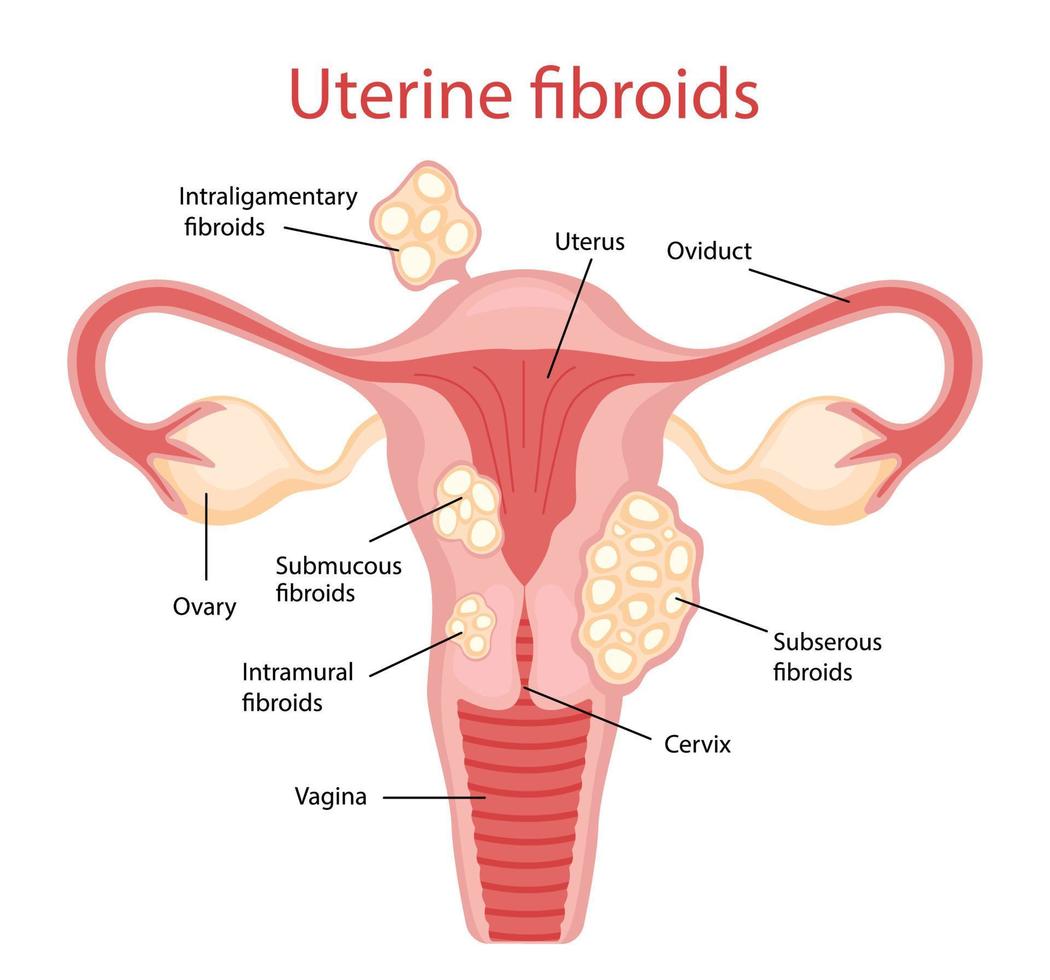 fibromas enfermedades del aparato reproductor femenino. ilustración vectorial en estilo de dibujos animados plana vector