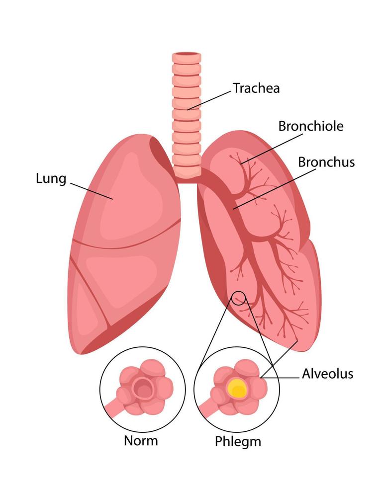 Pneumonia. Normal and inflammatory condition of the lungs and inflammation of the alveoli with fluid. vector illustration in cartoon style isolated on white background.