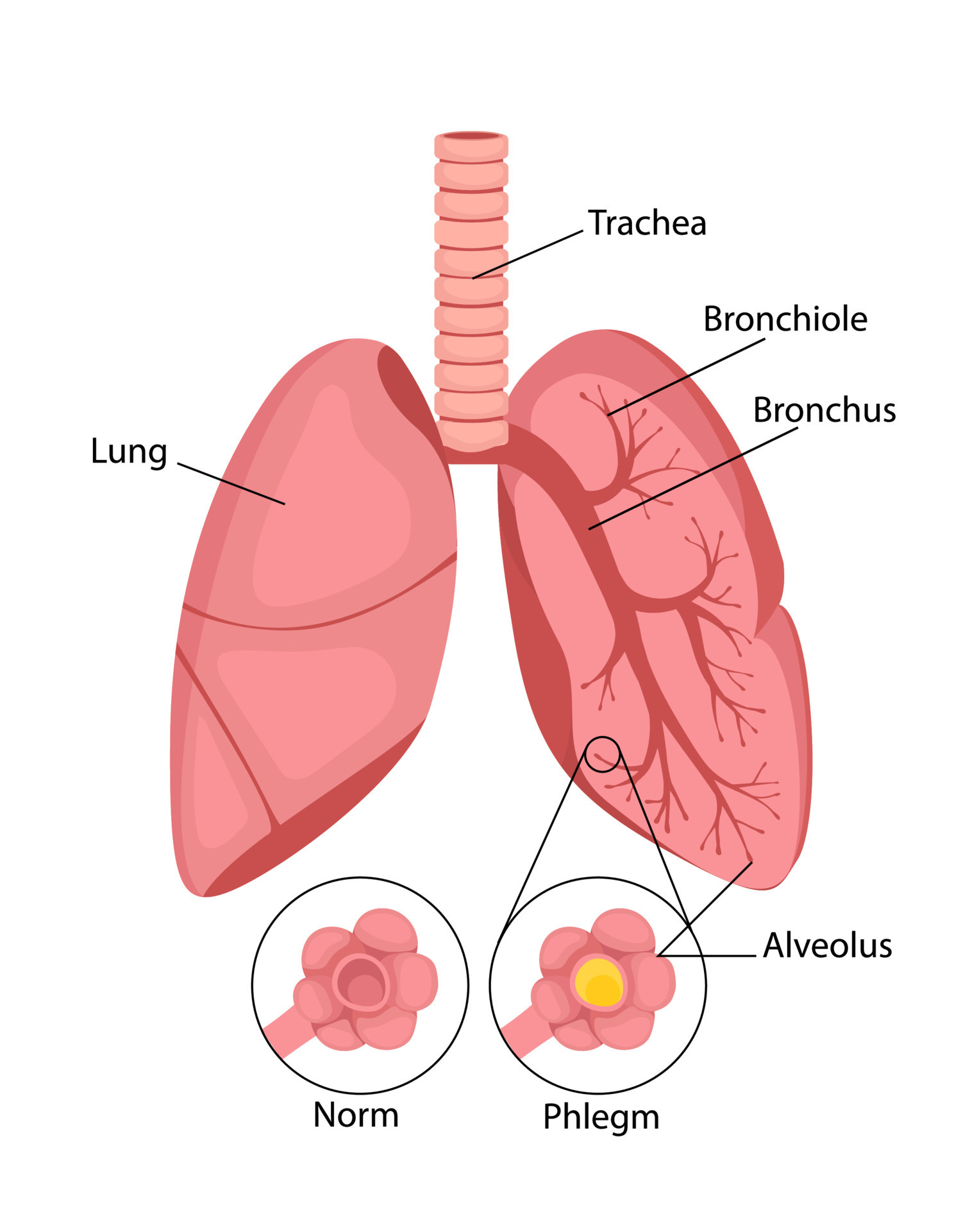 Pneumonia. Normal and inflammatory condition of the lungs and