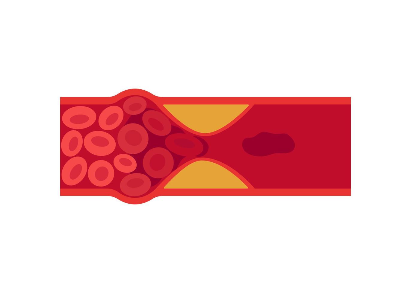 Blood clot, thrombus in vein or artery. Deep vein thrombosis DVT or arterial clot, artery and vein cholesterol sick, abnormally of blood vascular flow. Blocked circulation in blood vessel. Vector