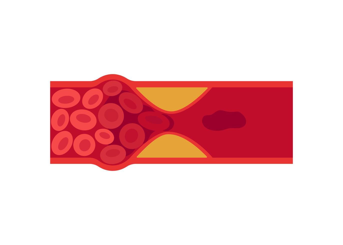 Blood clot, thrombus in vein or artery. Deep vein thrombosis DVT or arterial clot, artery and vein cholesterol sick, abnormally of blood vascular flow. Blocked circulation in blood vessel. Vector