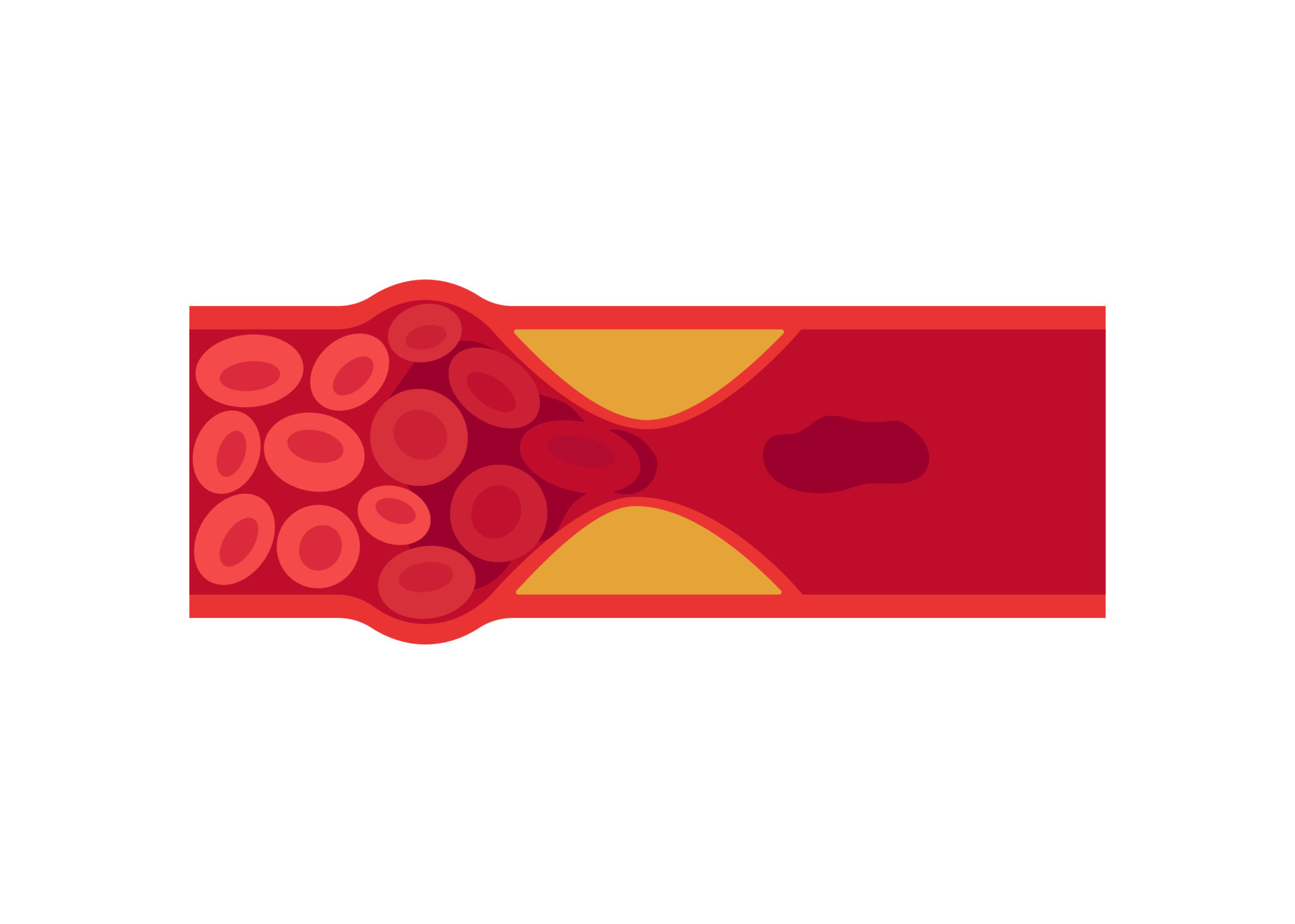 Blood clot, thrombus in vein or artery. Deep vein thrombosis DVT or(07)