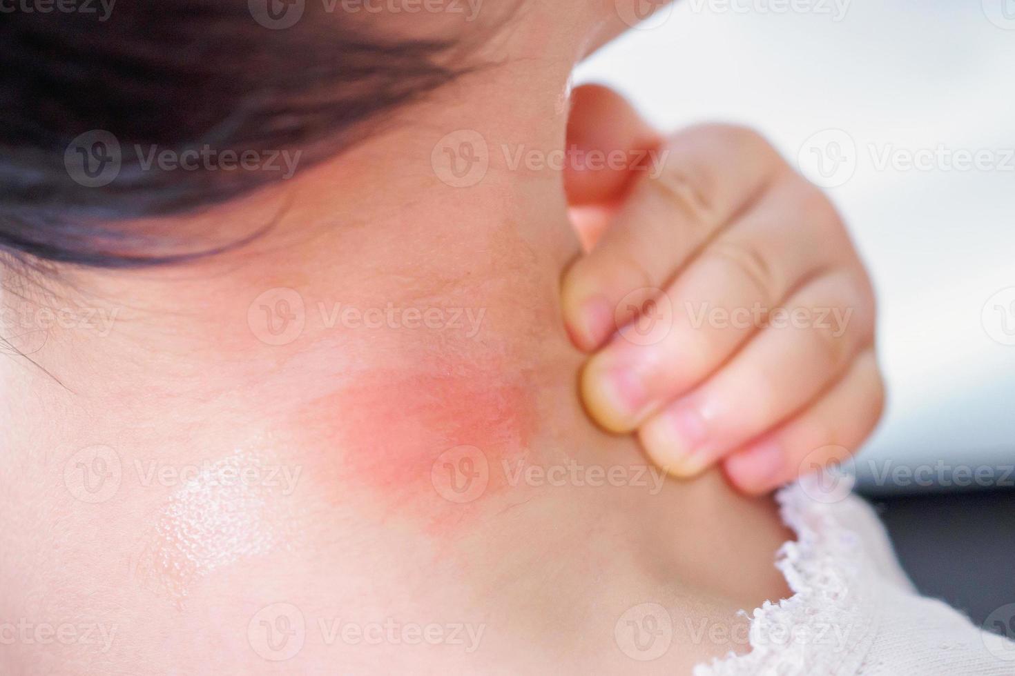 erupción cutánea del bebé y alergia con mancha roja causada por la picadura de mosquito en el cuello foto