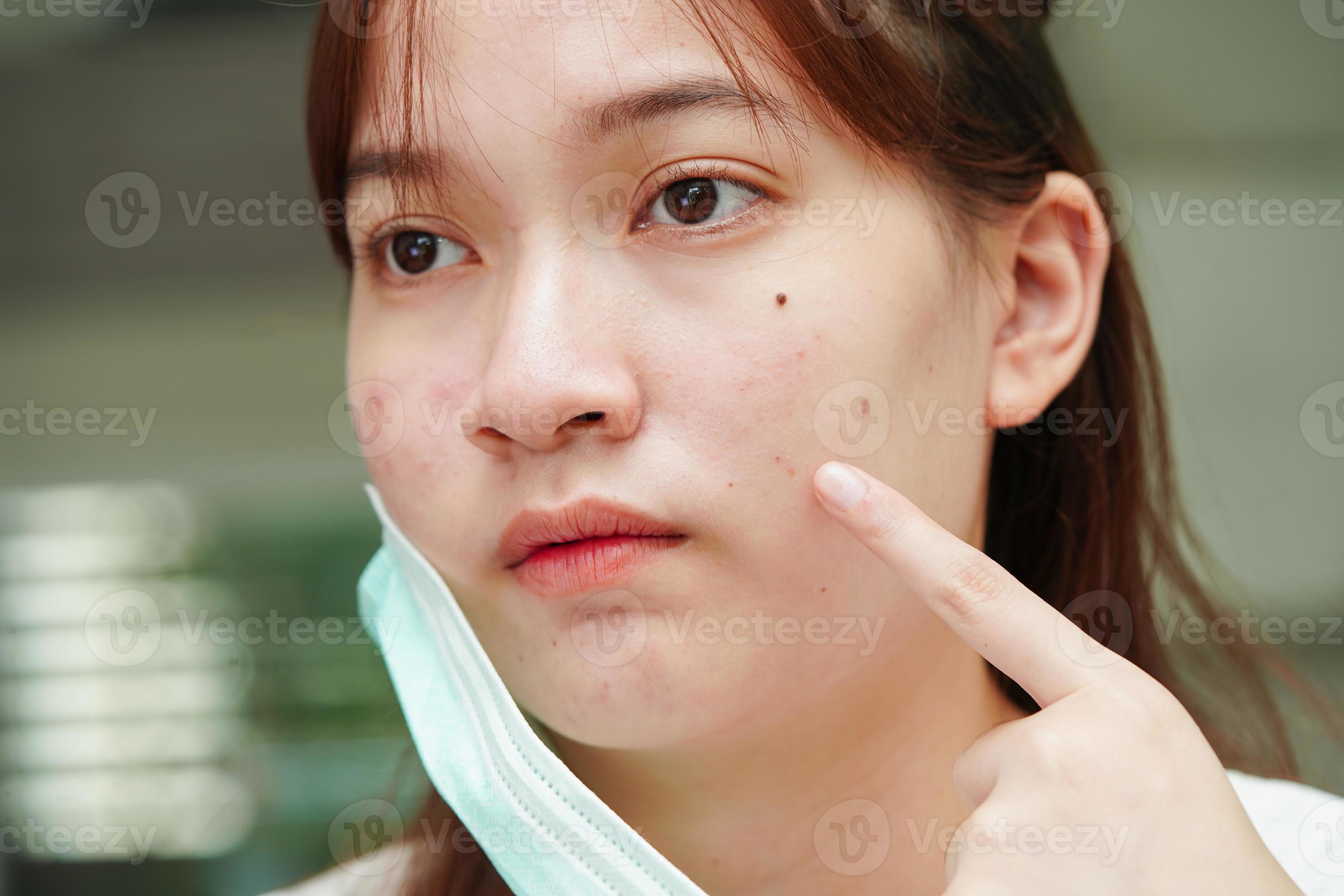 Disgusting Pimples - r2vya0y
