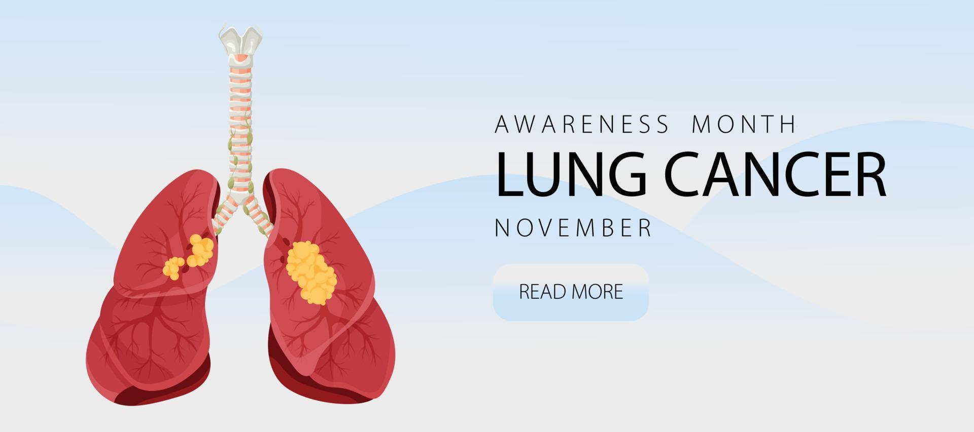Banner informing about lung cancer. Design template for websites, magazines. Vector illustration cartoon style.