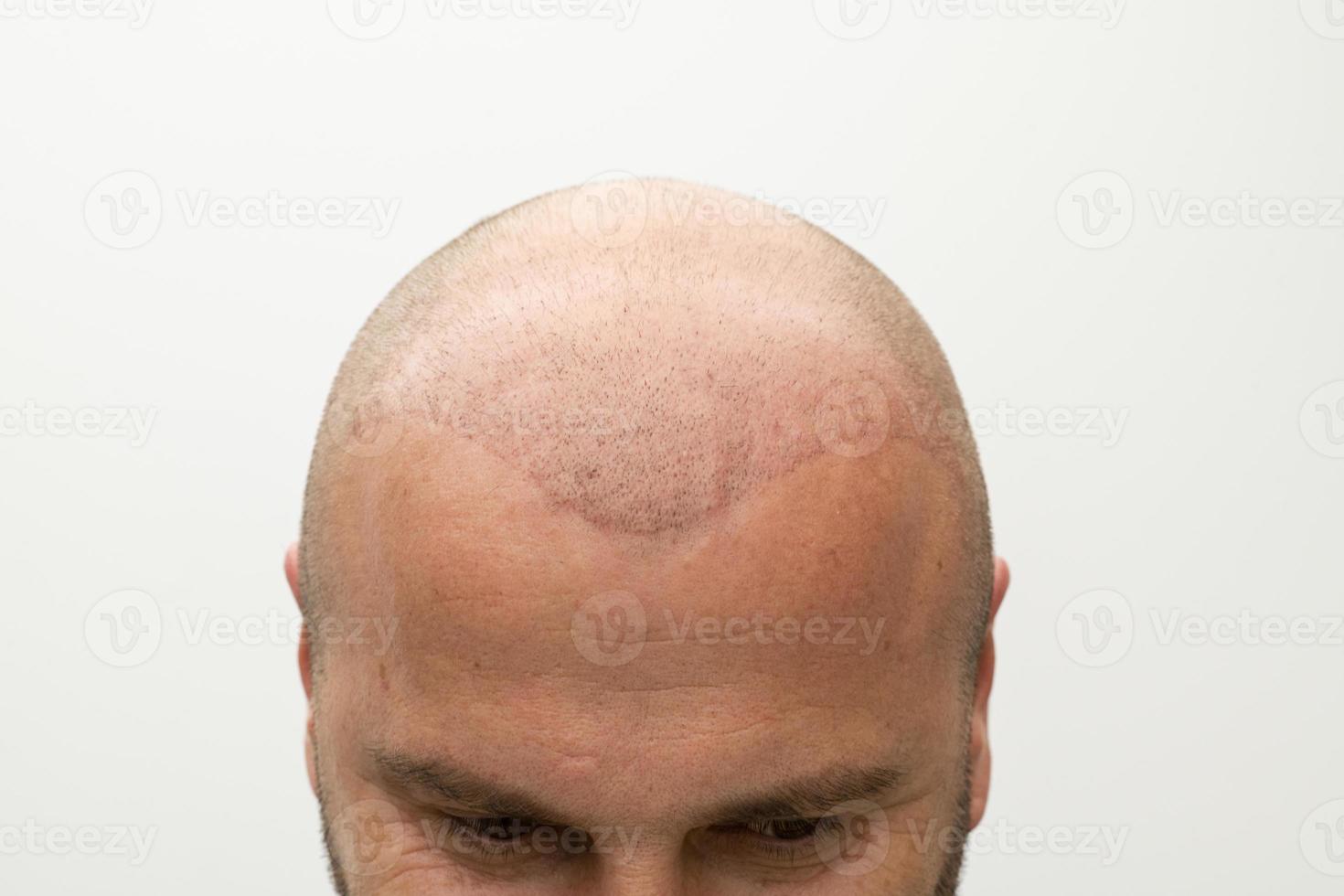 man after hair implant therapy photo