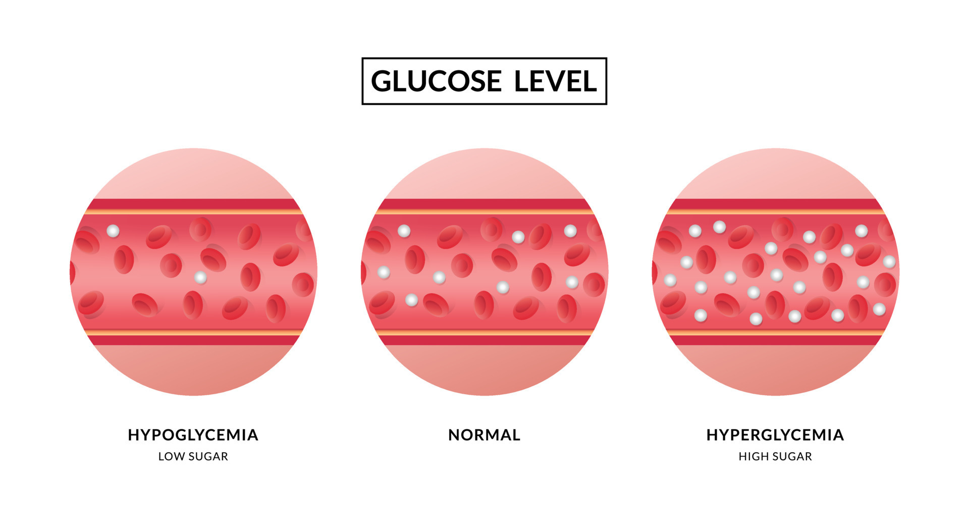 Glucose In The Blood Vessel Hypoglycemia And Hyperglycemia 10978448 