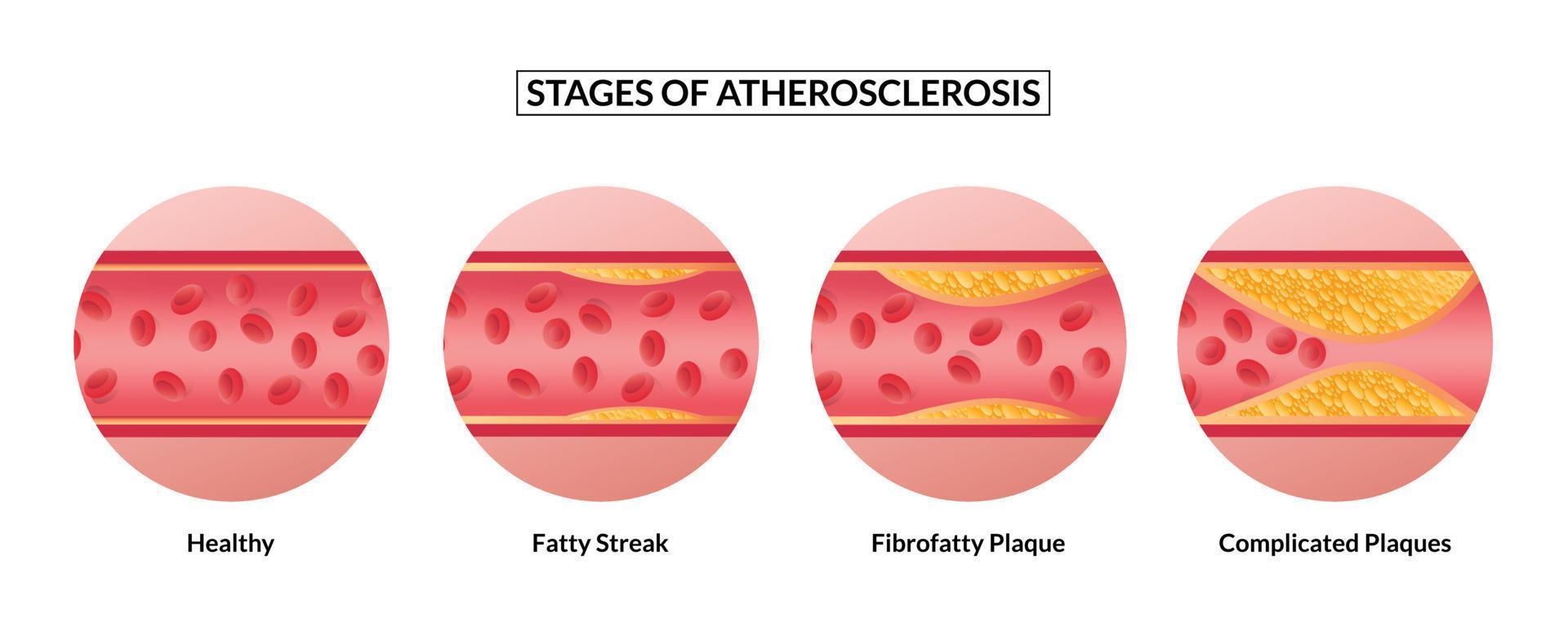 etapas de la aterosclerosis. formación de aterosclerosis arteria sana y arterias no sanas. vector