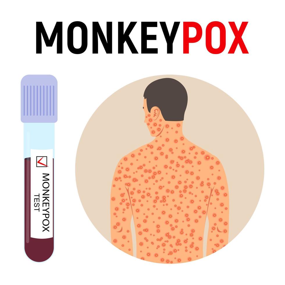 Monkeypox pandemic. A test tube with blood for a test and a man with a rash on his body is sick with smallpox. Disease symptoms. Vector illustration.