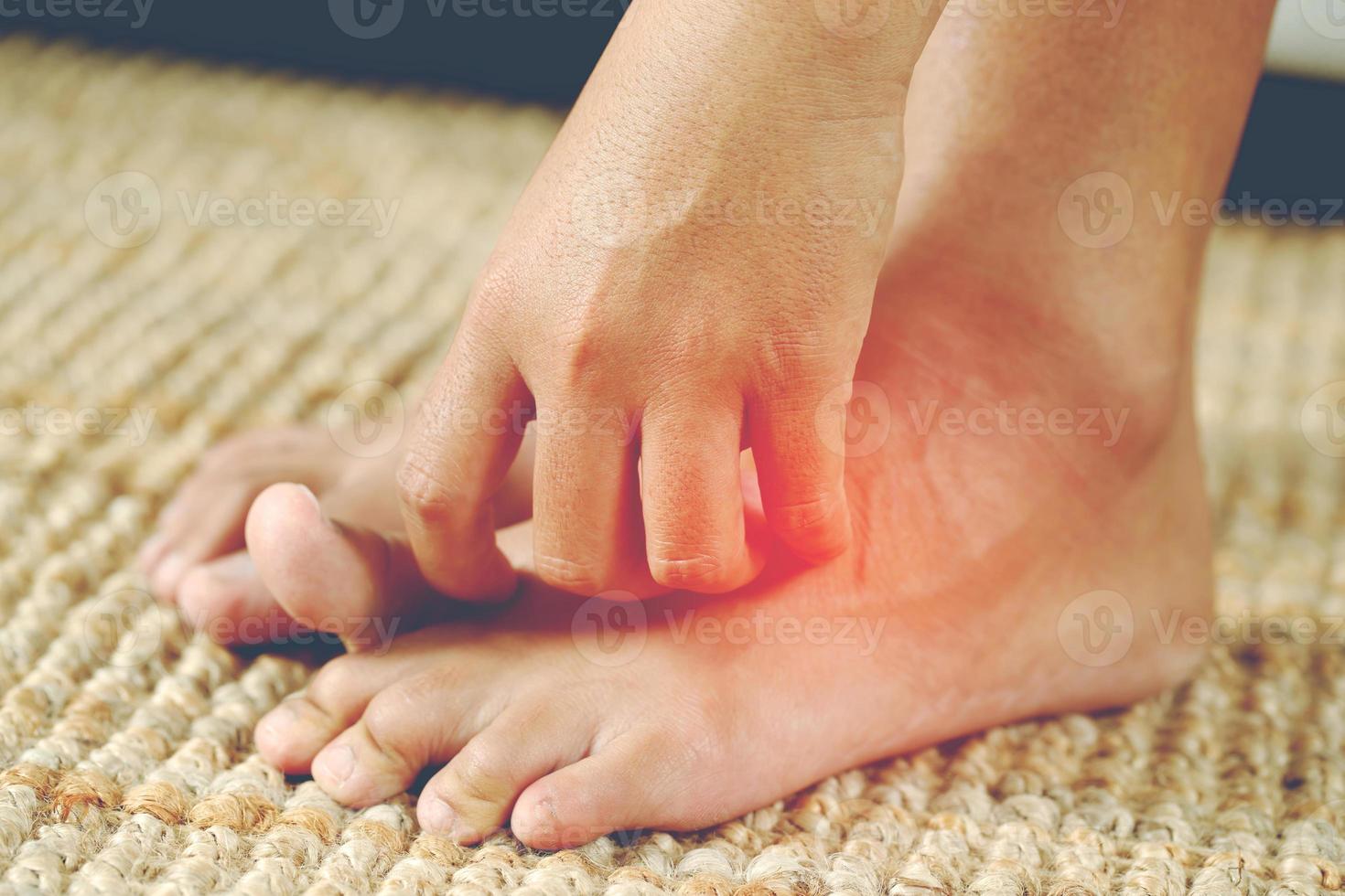 Fungal foot itching caused by biting feet 11004426 Stock Photo at Vecteezy