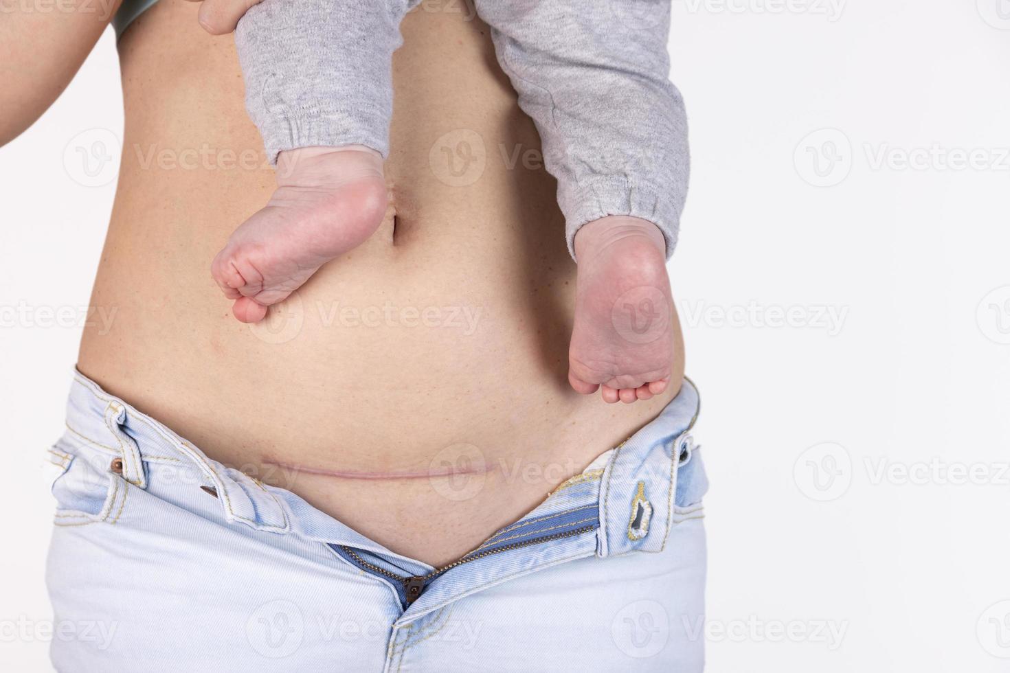 primer plano del vientre de una mujer con una cicatriz de cesárea, cinco meses después de dar a luz. mujer con un bebe en la mano foto
