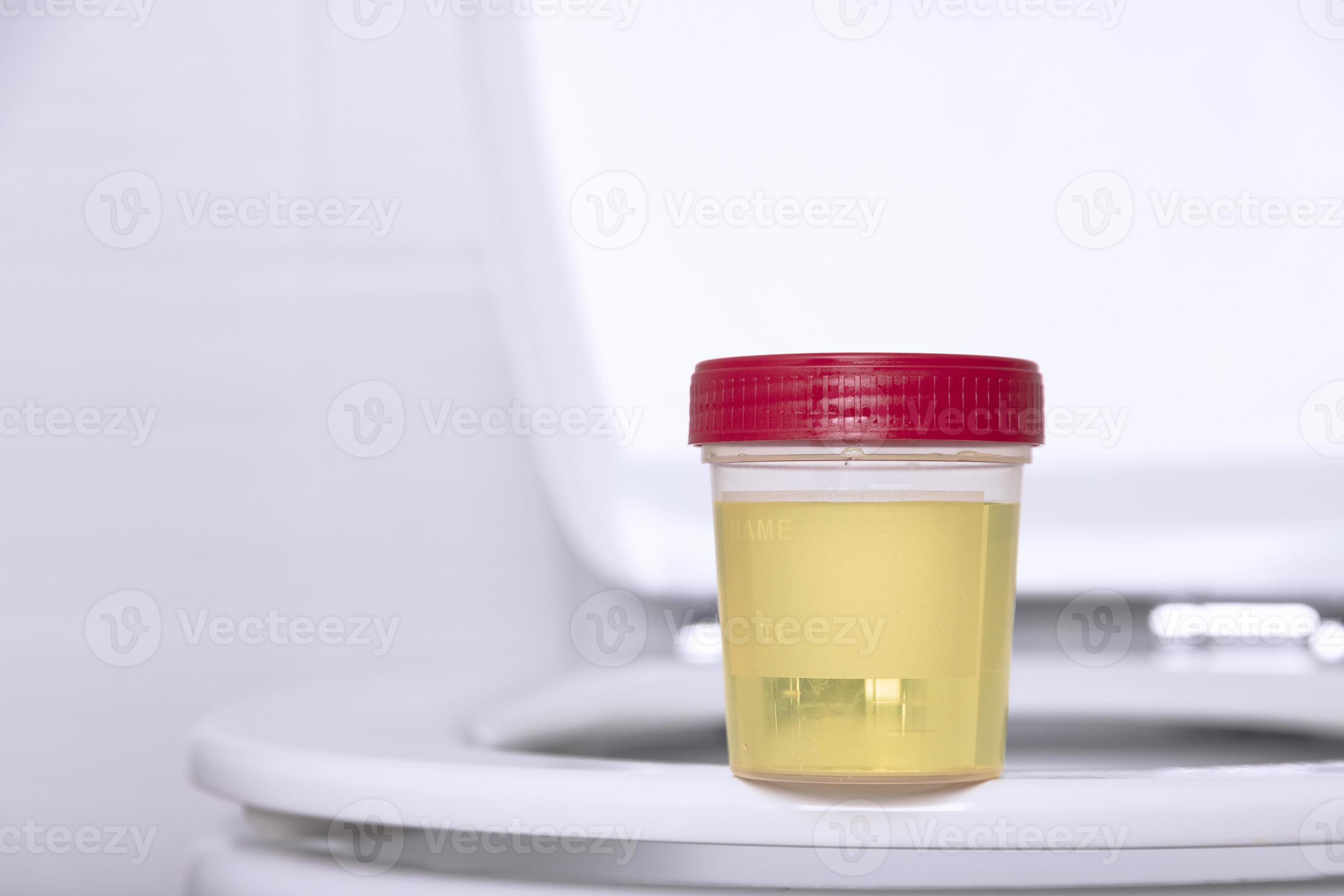 A urine sample in a medical container sits on the rim of a white