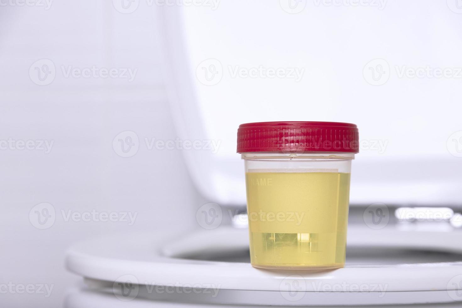 A urine sample in a medical container sits on the rim of a white household toilet. Selective focus. photo
