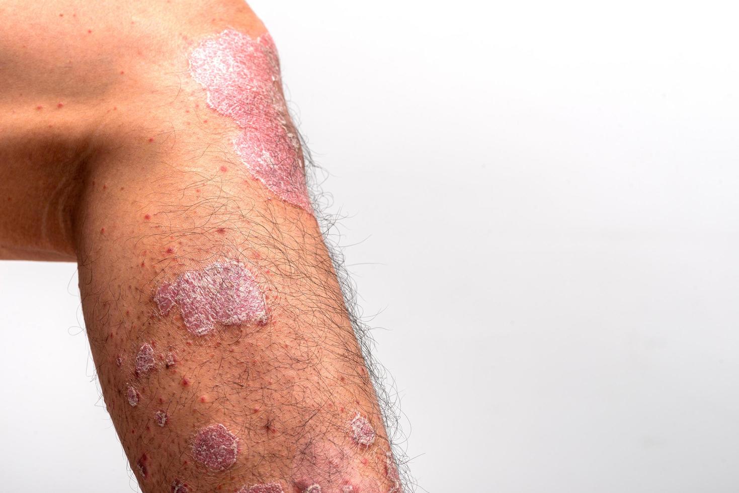 la psoriasis es esa rodilla sobre fondo blanco. foto