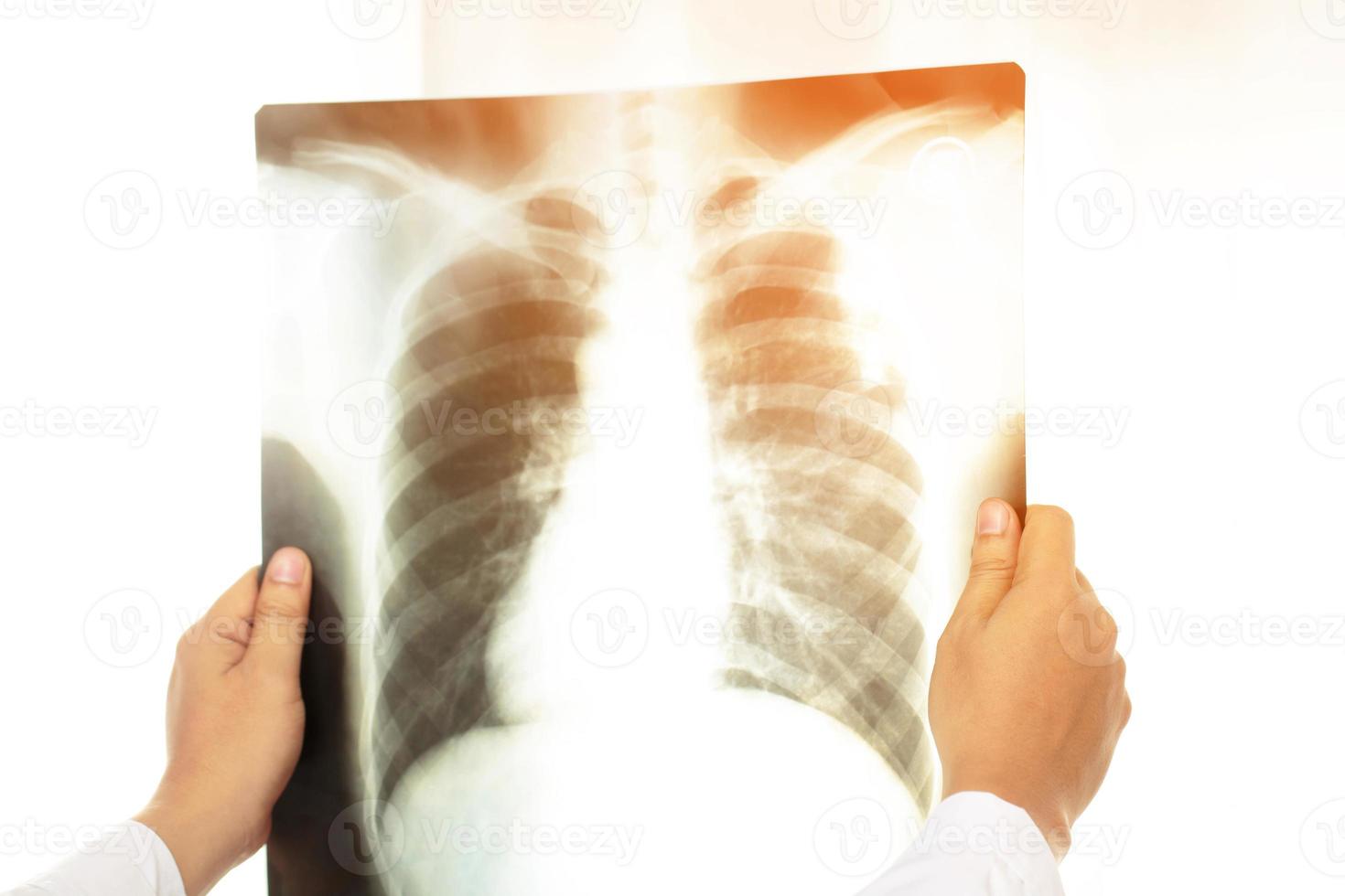 X-ray of the lungs is where X-rays are directed into a part of the chest or lungs where the radiograph images are recorded on film photo