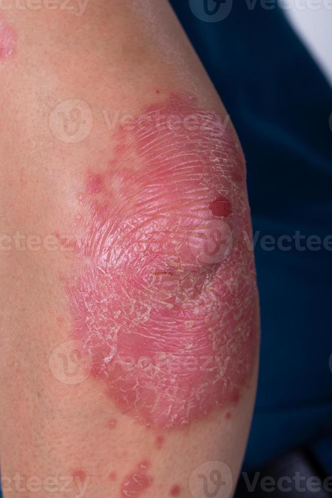 Unrecognizable man feel bad on skin disease called psoriasis. Large red, inflamed, rash on elbows photo