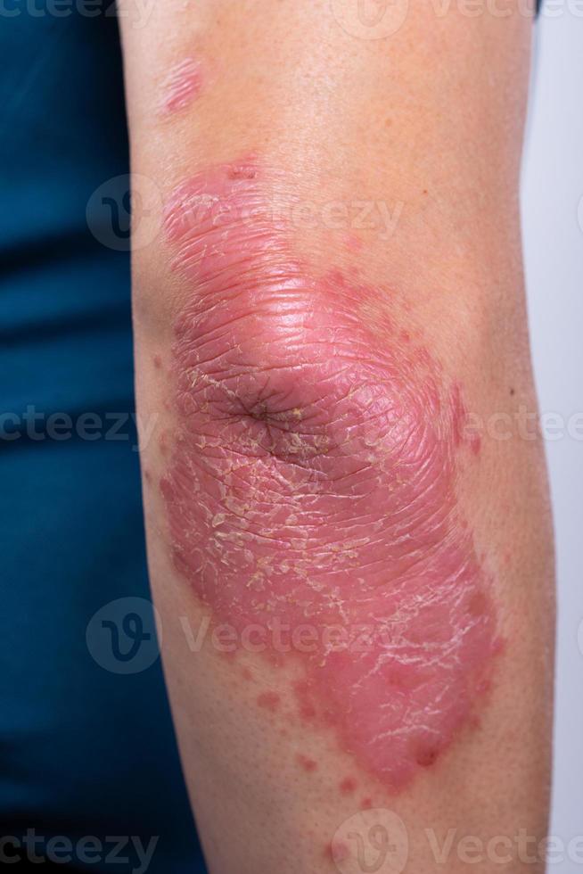 Unrecognizable man feel bad on skin disease called psoriasis. Large red, inflamed, rash on elbows photo