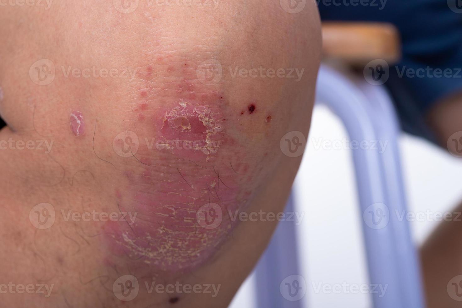 Unrecognizable man feel bad on skin disease called psoriasis. Large red, inflamed, rash on elbows photo