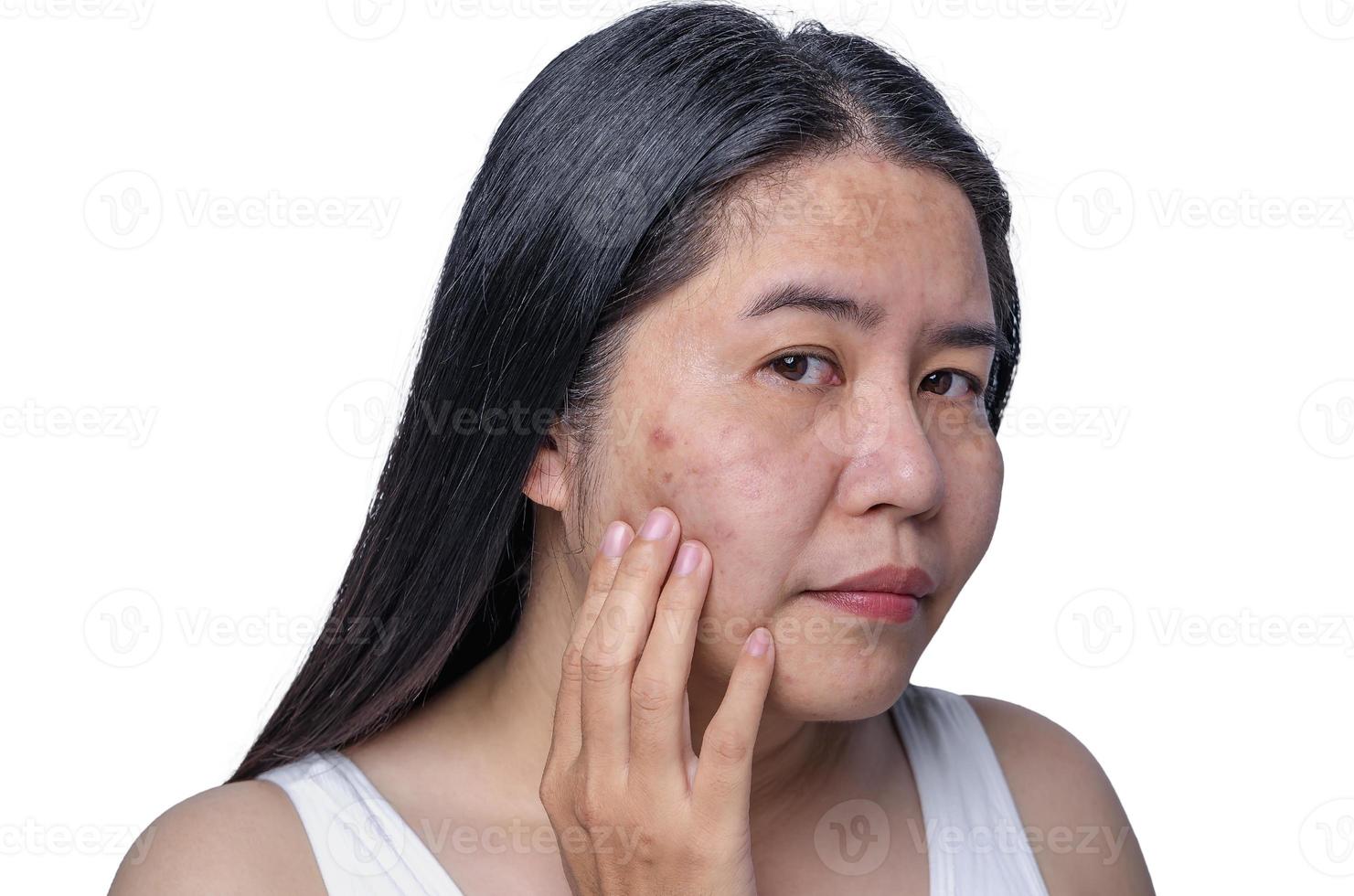 Asian adult woman face has freckles, large pores, blackhead pimple and scars problem from not take care for a long time. Skin problem face isolated white background. Treatment and Skincare concept photo