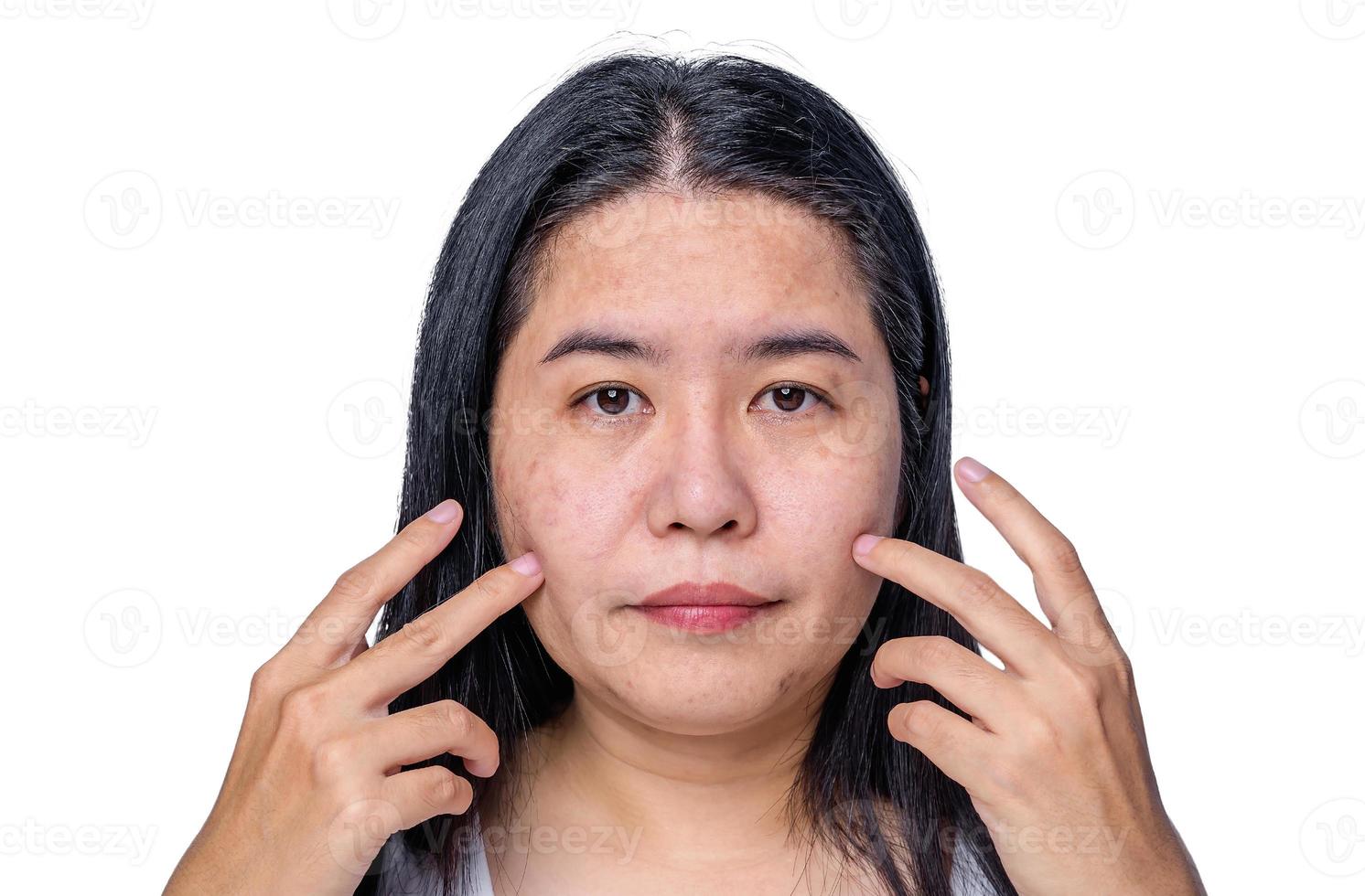 Asian adult woman face has freckles, large pores, blackhead pimple and scars problem from not take care for a long time. Skin problem face isolated white background. Treatment and Skincare concept photo