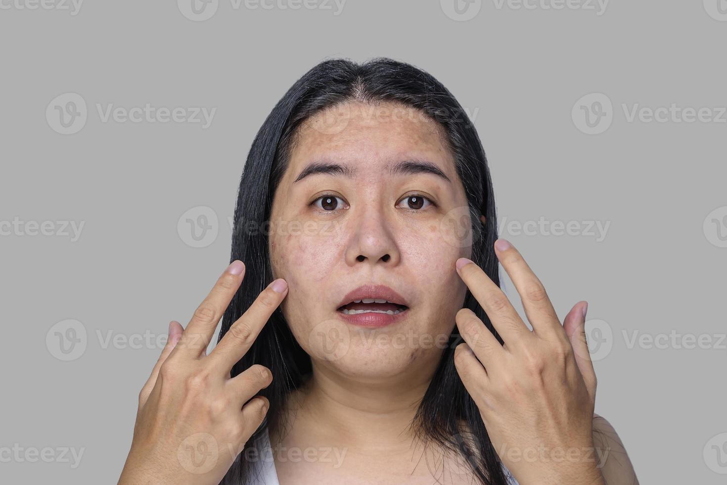 Asian adult woman face has freckles, large pores, blackhead pimple and scars problem from not take care for a long time. Skin problem face isolated gray background. Treatment and Skincare concept photo
