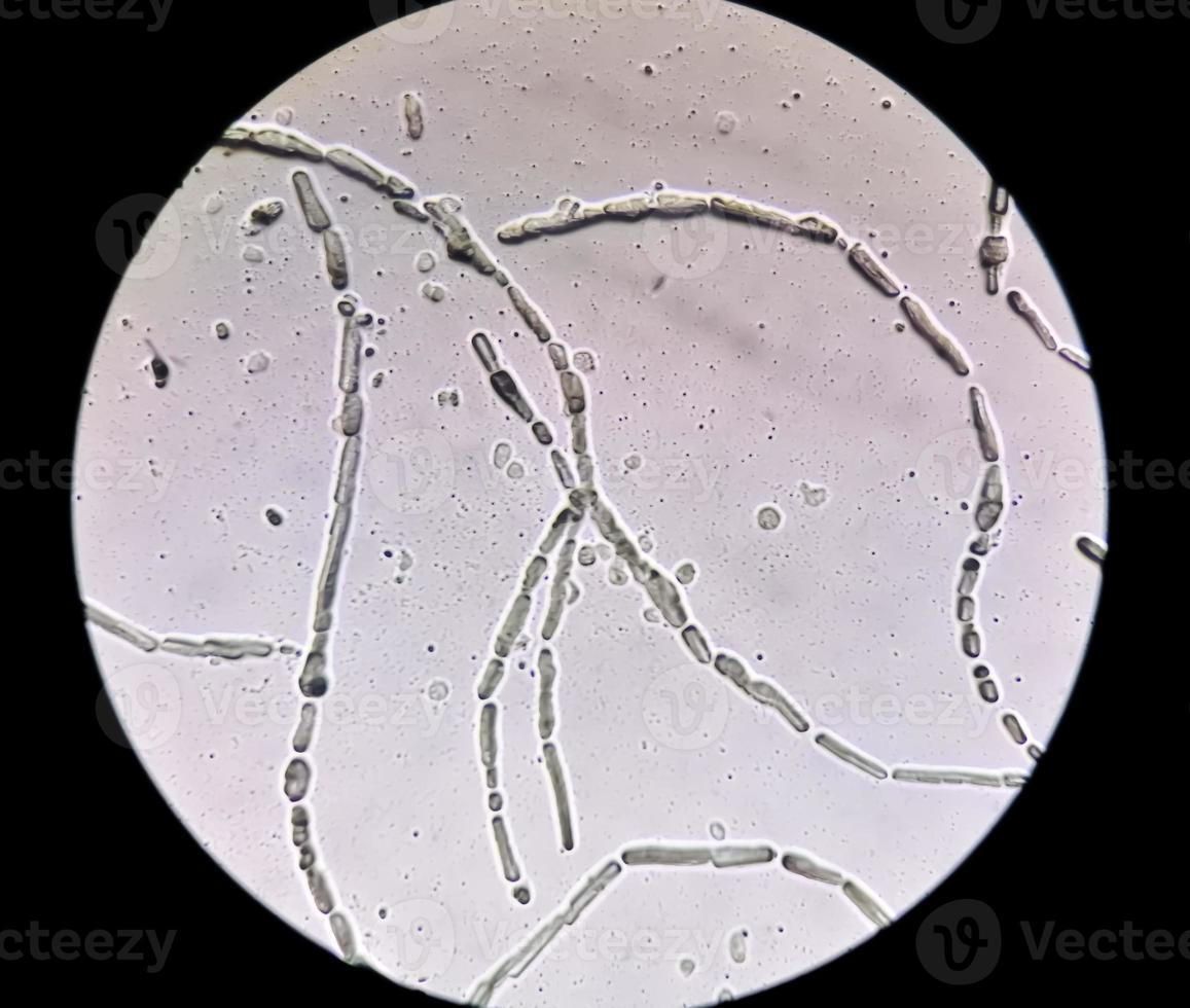 Photomicrograph showing Hyphae of dermatophytes, Nail scraping for fungus test photo
