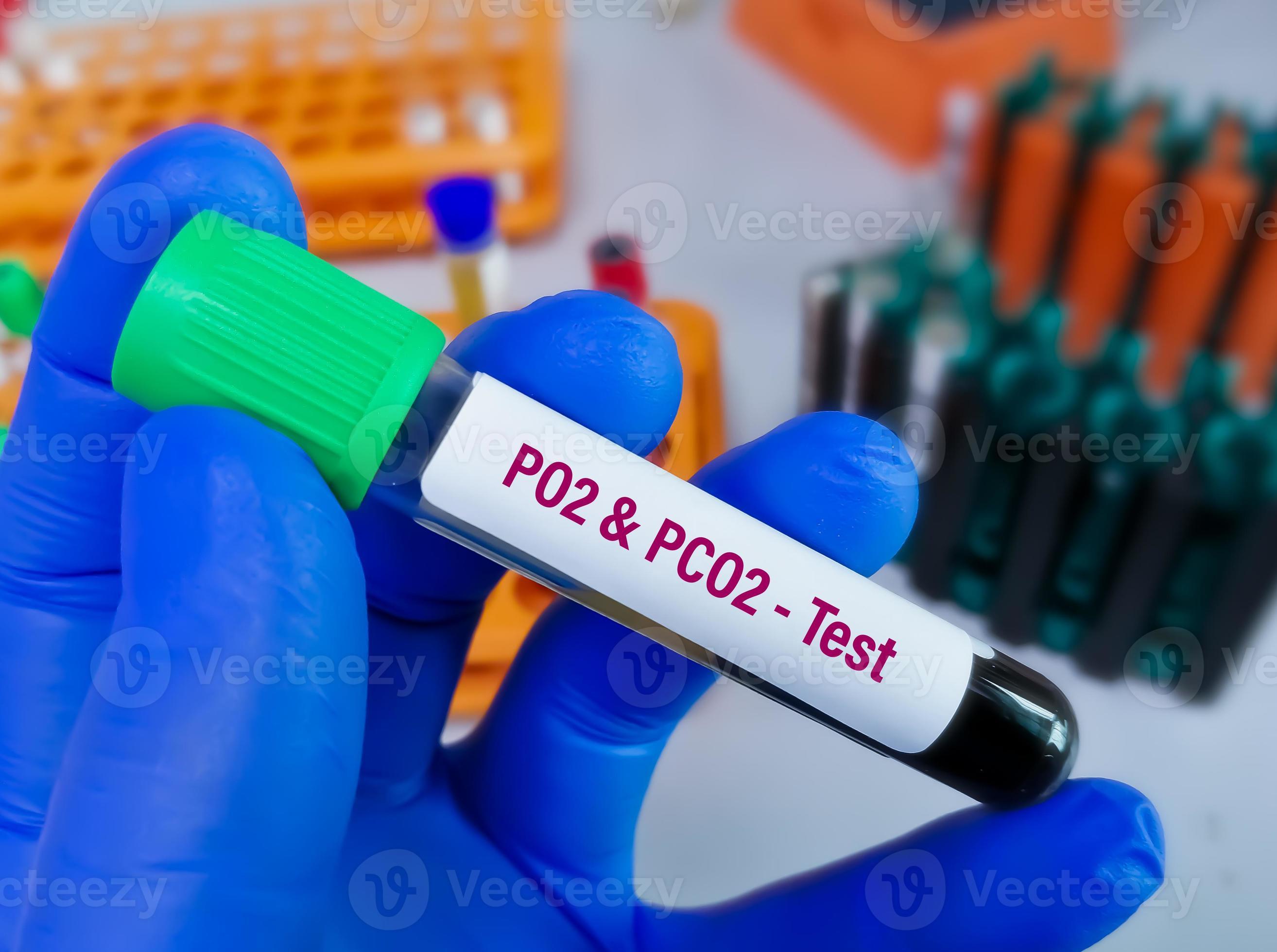 Blood Sample For PO2 Or Partial Pressure Of Oxygen And PCO2 Or Partial blood-sample-for-po2-or-partial-pressure-of-oxygen-and-pco2-or-partial
