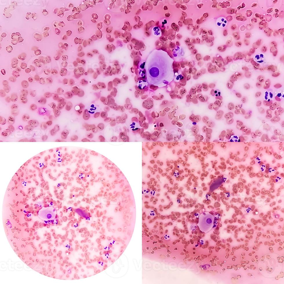 College of two microscopic image showing radiation induced changes. vault smear. photo