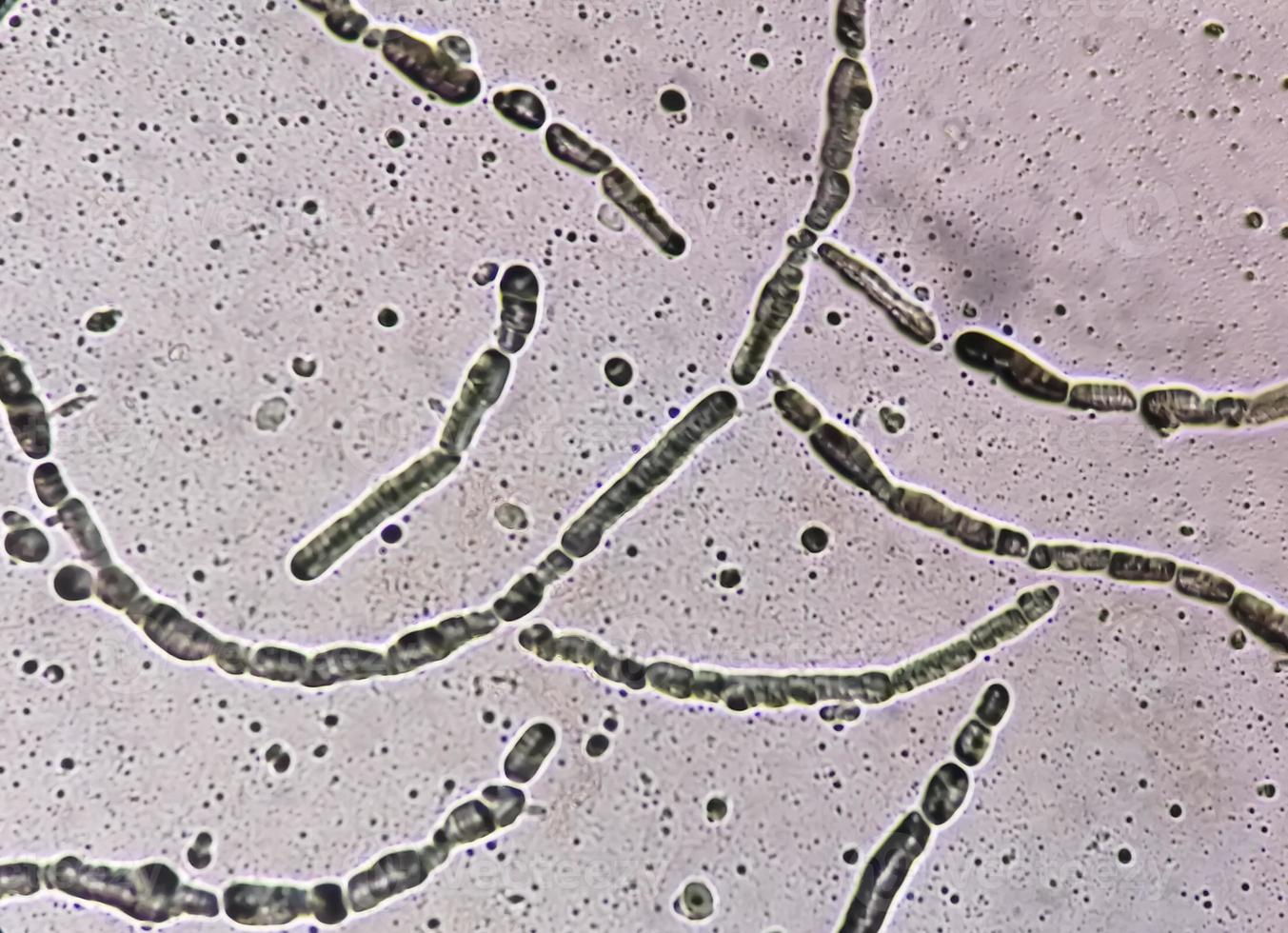 Photomicrograph showing Hyphae of dermatophytes, Nail scraping for fungus test photo