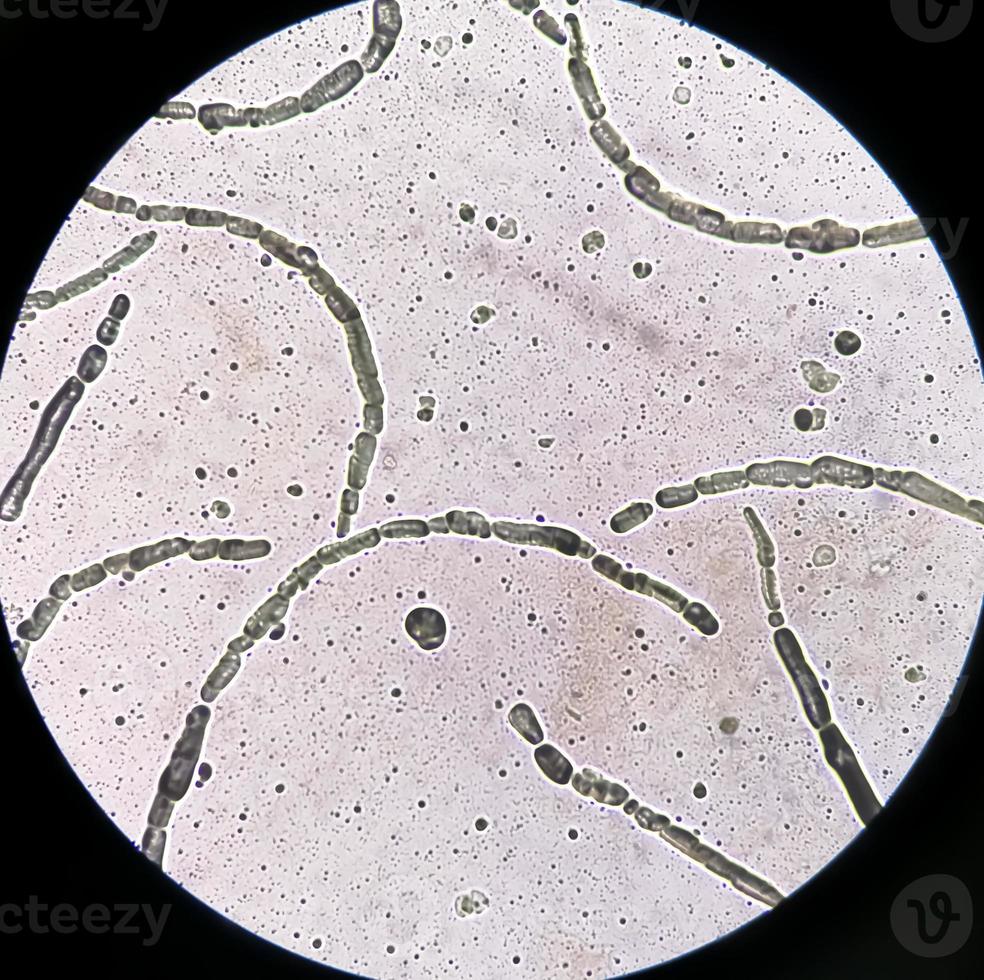 Photomicrograph showing Hyphae of dermatophytes, Nail scraping for fungus test photo