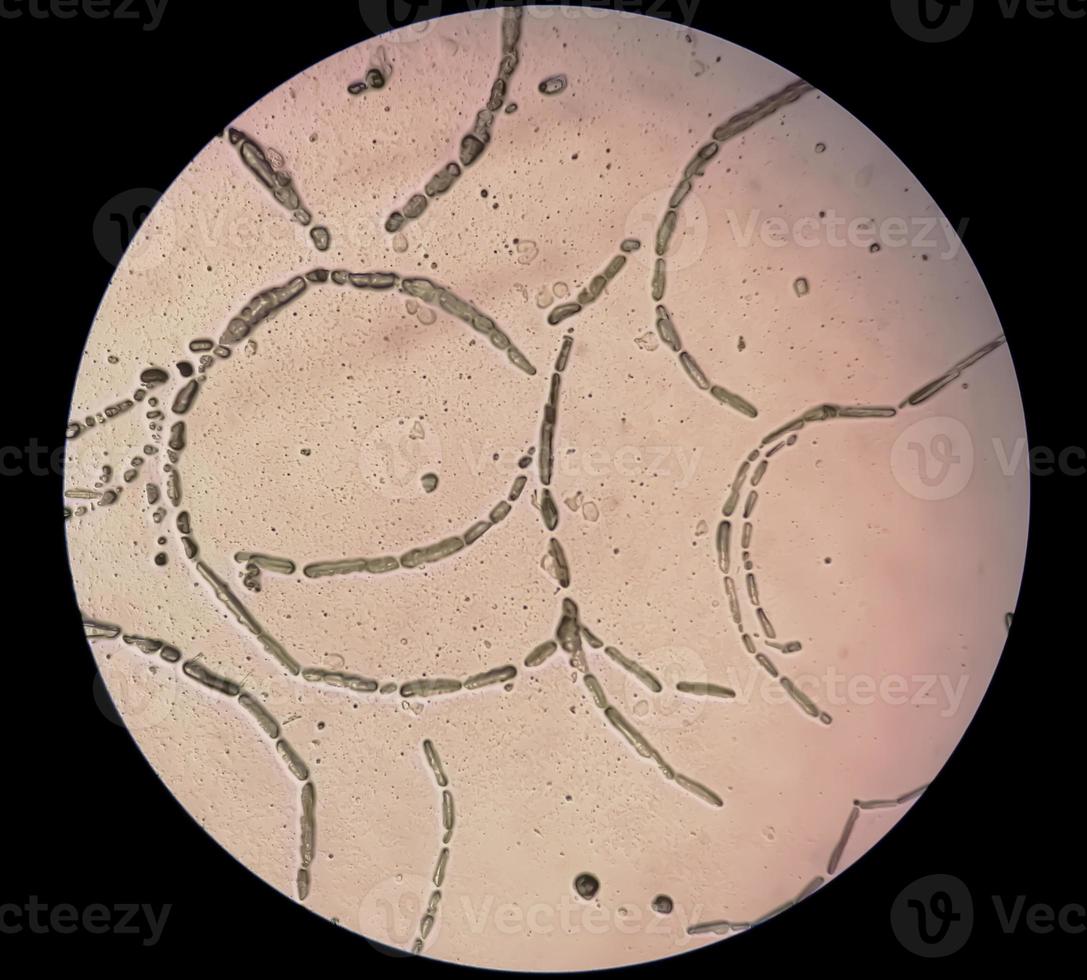 Photomicrograph showing Hyphae of dermatophytes, Nail scraping for fungus test photo
