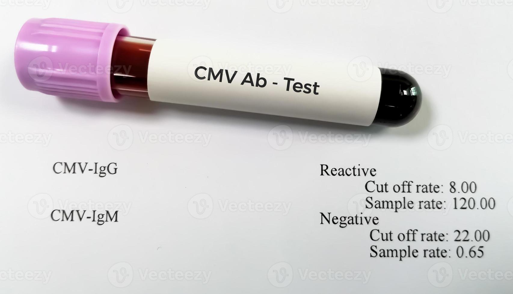 Blood sample tube for cytomegalovirus or CMV antibody testing with abnormal patient report. photo