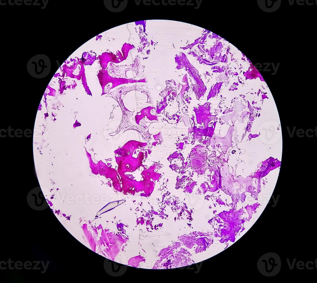 Enchondroma, Benign bone tumor. Microscopic image of enchondroma. photo