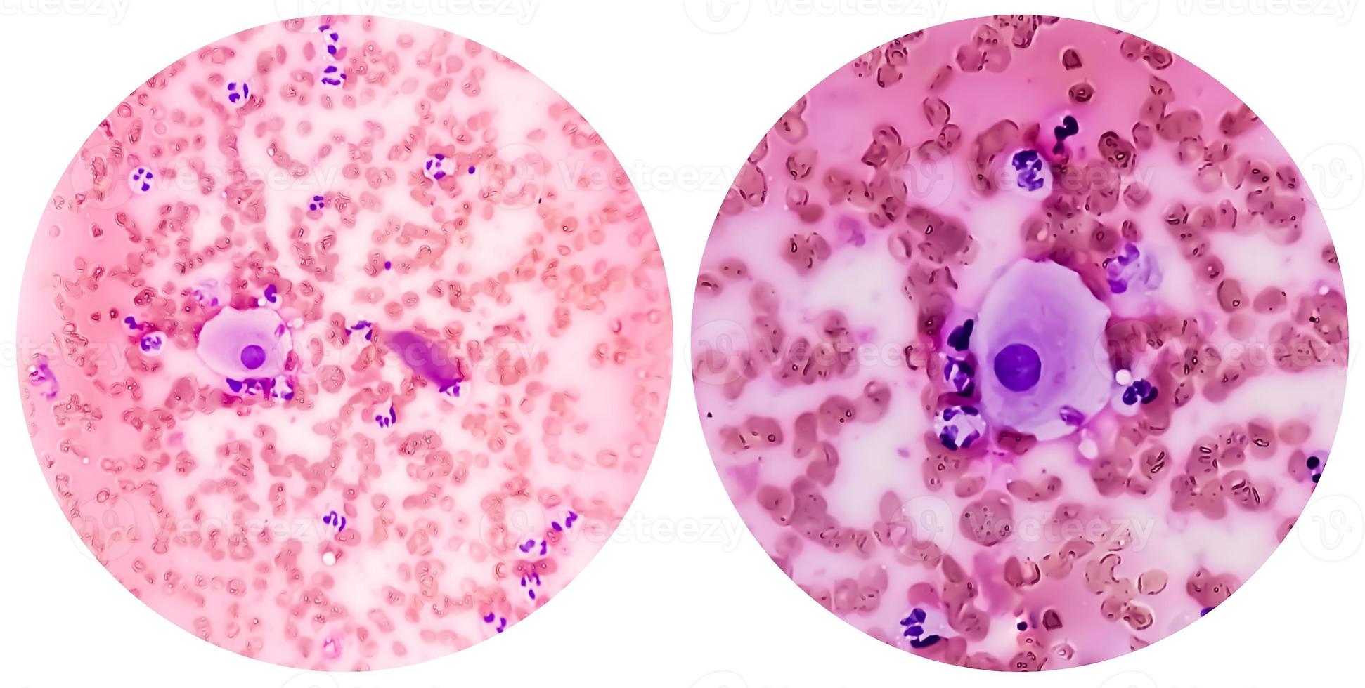 College of two microscopic image showing radiation induced changes. vault smear. photo